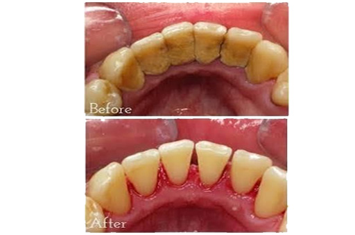 Scaling and Polishing Before and After image